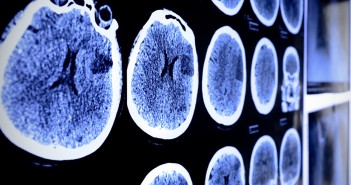 Could a blood test provide early prediction of Alzheimer’s progression? brain scan