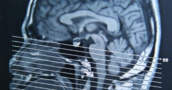 New biomarker associated with group of metabolic diseases brain-mri-cleaned-up