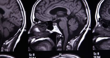 Brain tumor progression and response to treatment tracked by new imaging biomarker mri-scan-shutterstock_156416669