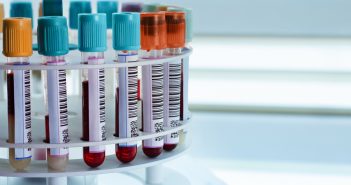 Evaluation of sample extraction methods for minimizing hematocrit effect on whole blood analysis with volumetric absorptive microsampling Blood tests