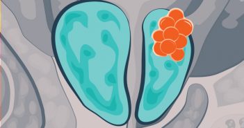 Could a blood test predict the outcome of prostate cancer treatment? prostate cancer approach