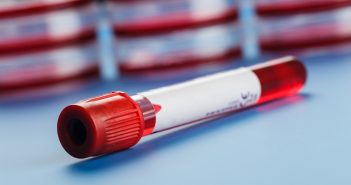 Huntington’s disease blood biomarker identified blood bio sample_136518500
