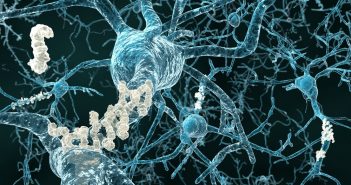 Newly identified biomarkers could aid Alzheimer’s diagnosis Alzheimer's disease - neurons with amyloid plaques 111506315