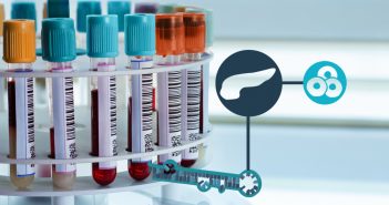 Could a blood test lead to early detection of pancreatic cancer? Blood samples to indicate pancreatic tumour