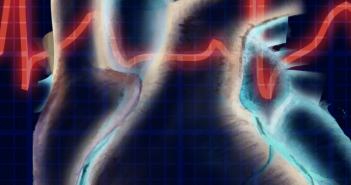 A peripheral blood transcriptome biomarker test to diagnose functional recovery potential in advanced heart failure Untitled design(12)