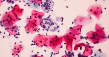 New microarray could improve cervical cancer diagnosis cervical epithelial cells