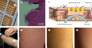 Microneedle biosensor could provide real-time measurements of antibiotic concentrations microneedle-biosensor