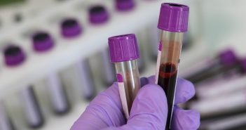 New blood test could reduce abdominal aortic aneurysm fatalities abdominal-aortic-aneurysm