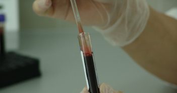 Could protein microarrays be used in the early detection of breast cancer? autoantibodies-blood-test
