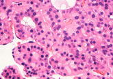 HCC biomarkers TGF-β