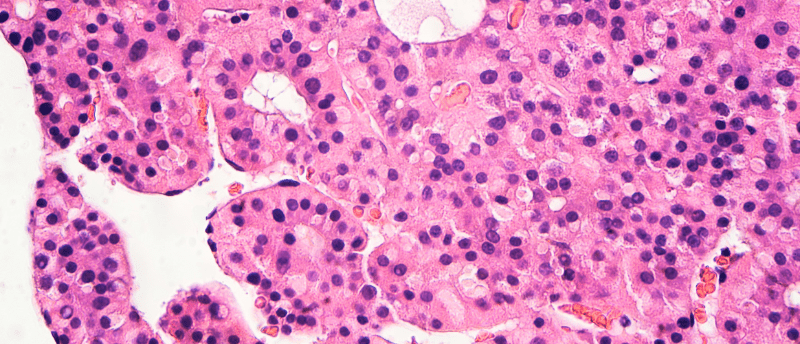 HCC biomarkers TGF-β